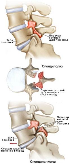 spondylolysis-spondylolisthesis.jpg