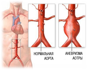 http://med-atlas.ru/wp-content/uploads/2017/05/anevrizma-aorty-bryushnoy-polosti.jpg