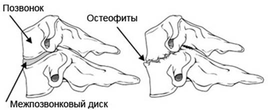 http://spinomed.ru/images/bolezni/spondilez.jpg