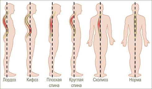 http://spinazdorov.ru/wp-content/uploads/2013/08/vidy-iskrivlenij-pozvonochnika.jpg
